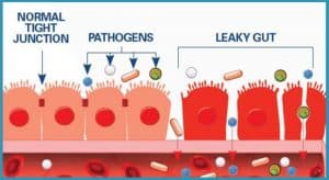 image showing normal gut vs leaky gut